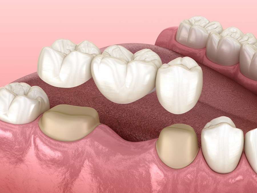 bridges vs implants, dental bridges, dental implants, replacing missing teeth, Middletown Commons Family Dental, Louisville KY, tooth restoration options, oral health solutions, dentist louisville